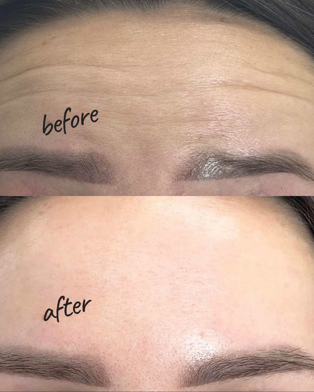 Before and After Botox Treatment Brooklyn NYC